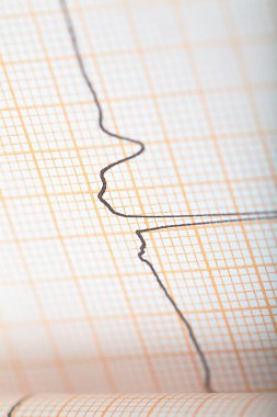 Bir konsept kalp koşulları tanı olarak EKG grafiği