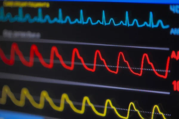 Waves ECG on monitor in perspective — Stock Photo, Image