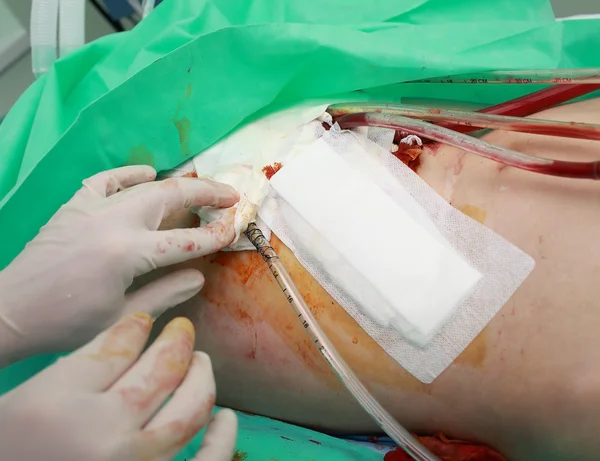 Herida operatoria después de la cirugía, tubos de drenaje —  Fotos de Stock