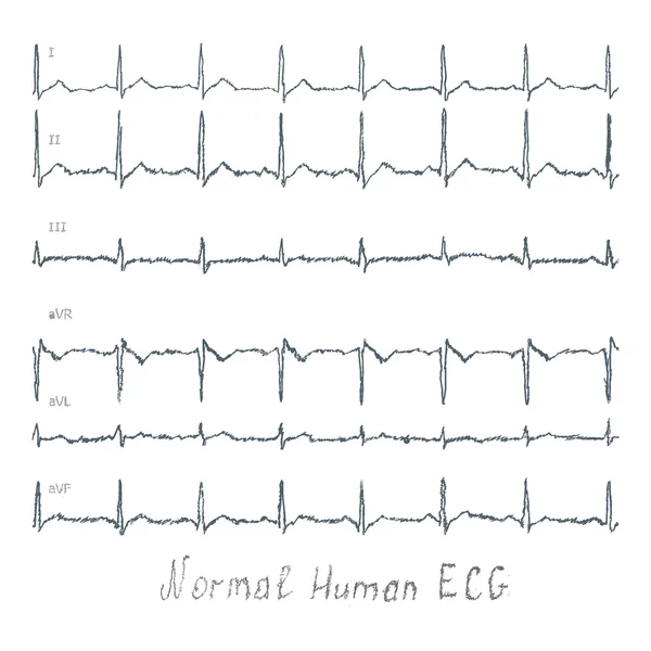 Ilustração humana ecg normal — Fotografia de Stock