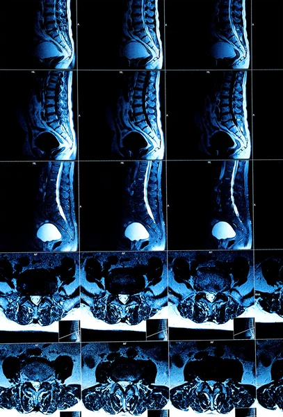 CT-scan afbeelding van wervelkolom — Stockfoto