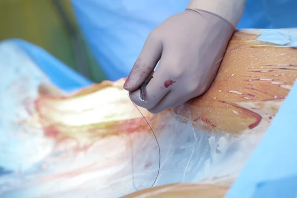 Surgeon sutures postoperative wound — Stock Photo, Image