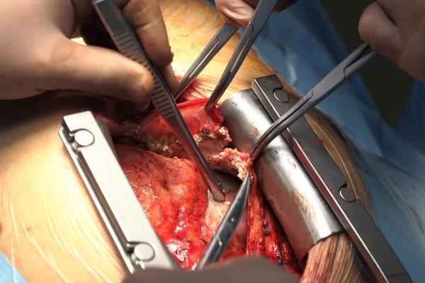 Cirugía cardiaca. Manos del cirujano durante la operación macro — Foto de Stock