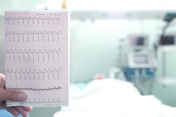 ECG con un ataque cardíaco en la sala de hospital — Foto de Stock