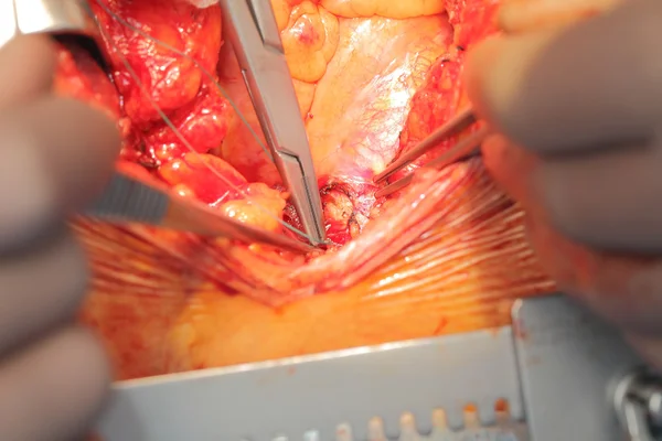 Kardiovaskulární operace makro — Stock fotografie