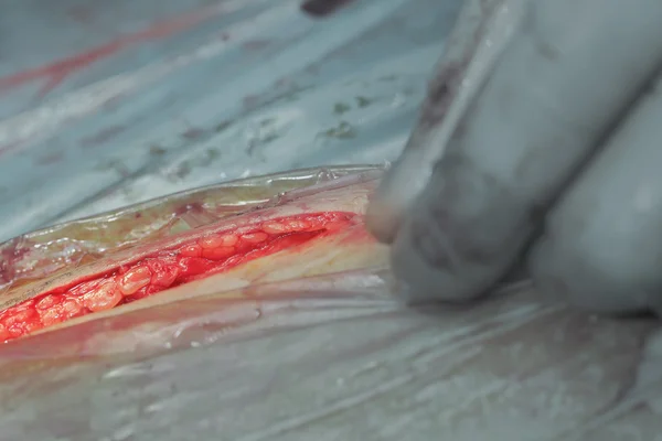 Disekce kůže během operace — Stock fotografie