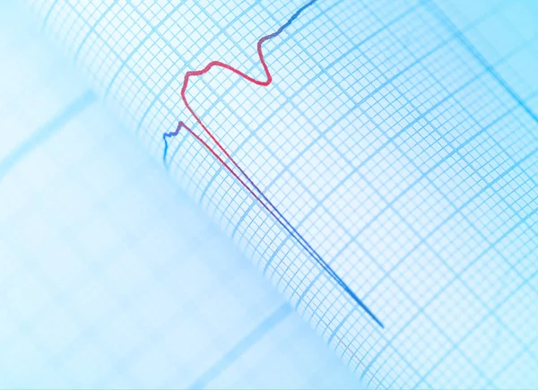 Sinal de perigo no ECG do paciente, close-up — Fotografia de Stock