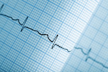 Elektrokardiyogram grafik kağıt üzerinde