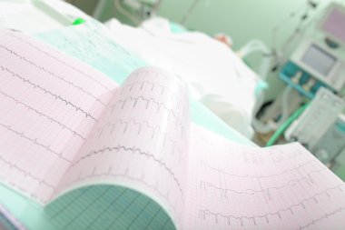 Kardiyogram Akut kalp yetmezliği olan bir hastanın