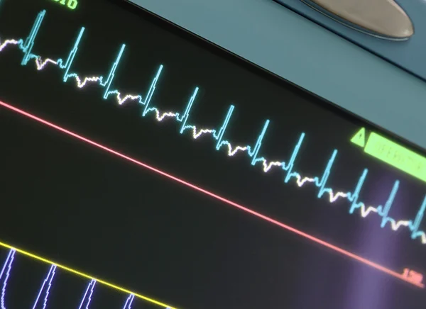 Display with ECG-curve — Stock Photo, Image