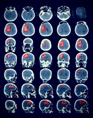 İnsan beyni ile patoloji görüntüsü