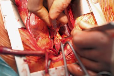 Kalp cerrahisi makro