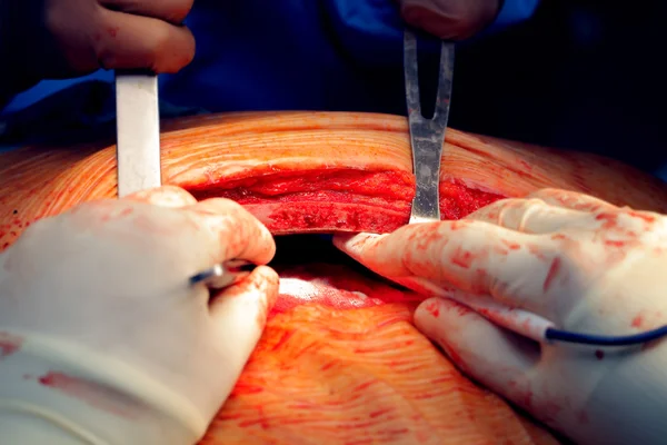 Dissection of the sternum during surgery — Stock Photo, Image