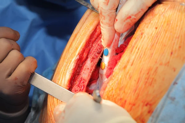 Cirujanos trabajando con el tórax disecado —  Fotos de Stock