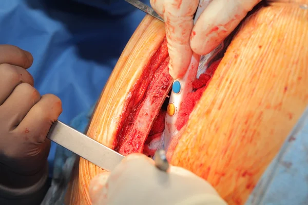 Surgeons working with dissected chest — Stock Photo, Image