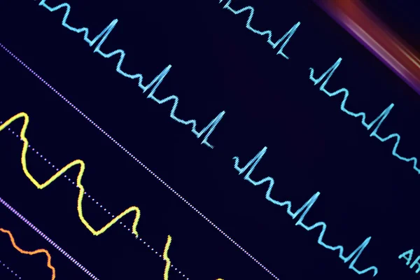 Színes EKG-hullámok, a monitoron — Stock Fotó