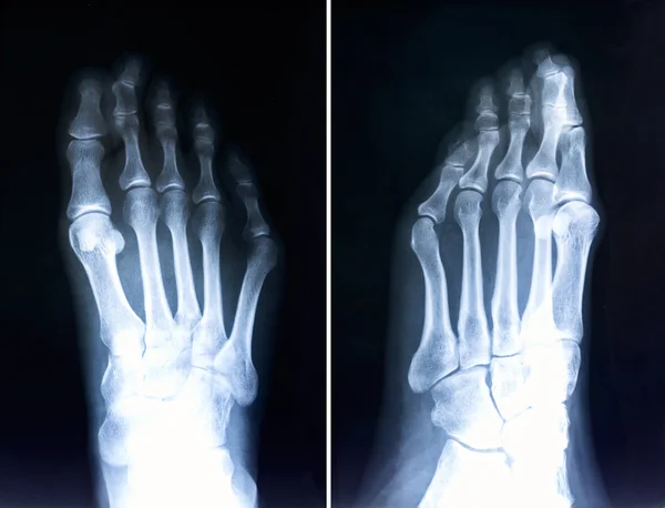 Rayons X des doigts des pieds.Radiographie avec orteils déformés.Hallux valg — Photo