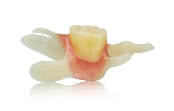 Dentadura artificial única - dente falso - prótese elástica — Fotografia de Stock