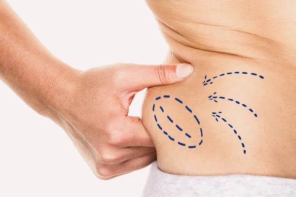 Zsírleszívás plasztikai sebészet jelek vonalak a női test zsír csökkentése derék körül. Karcsú nők társadalmi nyomás — Stock Fotó