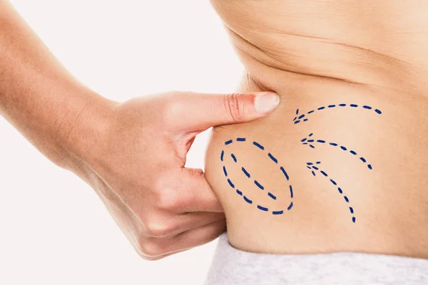 Liposuccion chirurgie plastique marque des lignes sur le corps de la femme pour la réduction de la graisse autour de la taille. Mince femmes pression sociale — Photo