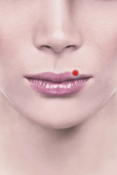 Ψυχρή πληγή blister κόκκινο σπυράκι στα πάνω χείλη της γυναίκας με έρπη. Εικόνα σχεδίασης για την έννοια — Φωτογραφία Αρχείου
