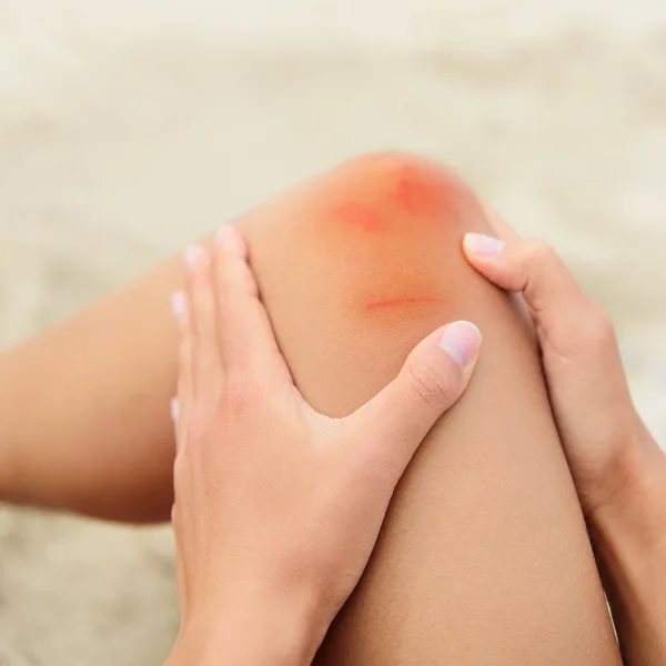 Woman with an injured bruised knee — Stock Photo, Image
