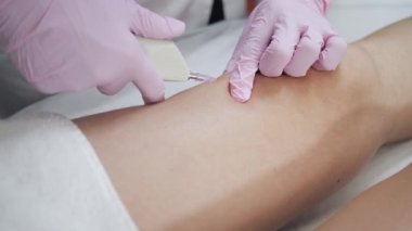 Doktor karbondioksiti hastanın bacağına karbondioksitle enjekte ediyor. Doktor kadın özel aletler kullanıyor. Deri etiketlerinin ve esneme hareketlerinin tedavisi ve çıkarılması. Mezoterapi, ozon terapisi.