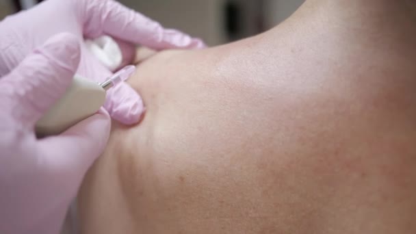클로즈업. 이산화 탄소 카르복시 요법. 피부 원기 회복. 환자의 어깨 위에서 시술 된다 — 비디오
