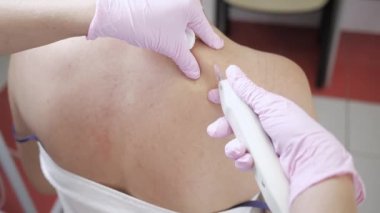 Doktor karbondioksit karbondioksit tedavisi yapıyor. Cilt tazeleme. Prosedür hastaların omuzlarında yapılır. Yakın plan.