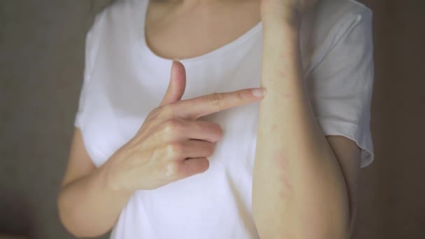 Mujer joven señala con el dedo un sarpullido rojo y rasca la alergia en su mano en primer plano. Reacción alérgica. Inflamación de la piel — Vídeos de Stock