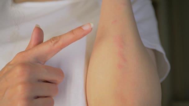 Młoda kobieta wskazuje palcem na czerwoną wysypkę i alergię na ręce w zbliżeniu. Reakcja alergiczna. Zapalenie skóry — Wideo stockowe