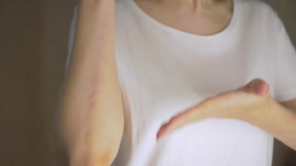 Giovane donna che soffre di prurito sulla mano della pelle e graffiare un luogo pruriginoso. Reazione allergica a punture di insetti, dermatiti, cibo e medicine. Eruzione allergica — Video Stock