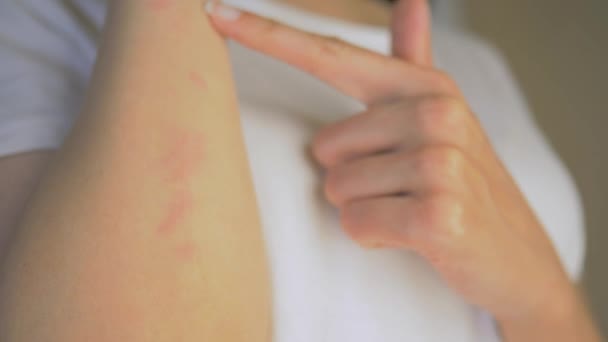 Жінка подряпає шкіру запаленням. Алергічна реакція, свербіж є симптомом захворювання. Запалення шкіри. крупним планом — стокове відео