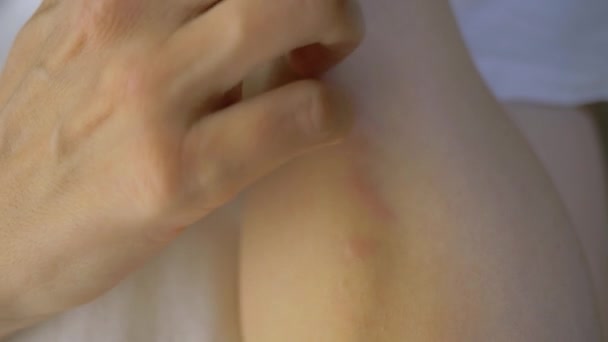 Mujer con enfermedad de la piel. El primer plano muestra el brazo. En la superficie del sitio hay manchas de erupción rojiza. Dermatitis alérgica. Movimiento lento — Vídeos de Stock