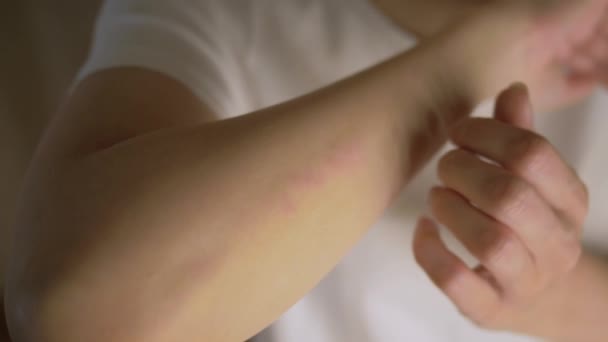 У женщины сыпь или папула и царапина на руке от аллергии. Проблемы с аллергией на кожу. Псориаз обыкновенный — стоковое видео