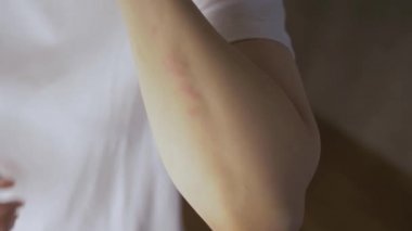 Yakın plan kadın, yakın plan çekimde eline kırmızı bir kızarıklık çizmiş. Alerji reaksiyonu ve deri hastalıkları