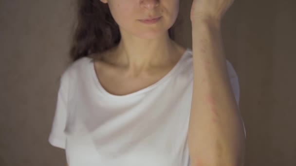 Mujer que sufre de picazón en la piel y arañar un lugar con picazón. Reacción alérgica a las picaduras de insectos, dermatitis, alimentos y medicamentos píldoras. Erupción alérgica — Vídeos de Stock