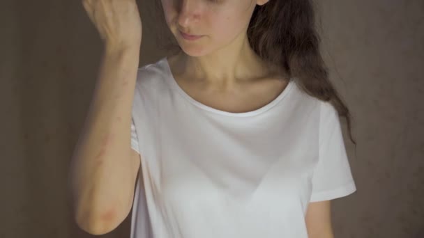 Hautallergie. Frau zeigt Allergien und kratzt sich die Hand. — Stockvideo