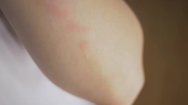 Una donna in primo piano gli gratta un'eruzione cutanea rossa sulla mano in primo piano. Reazione allergica e malattie della pelle — Video Stock