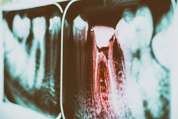 Pain Of Tooth Decay On Teeth X-Ray — Stock Photo, Image