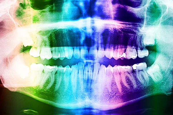 Dental X-Ray Of Teeth — Stock Photo, Image