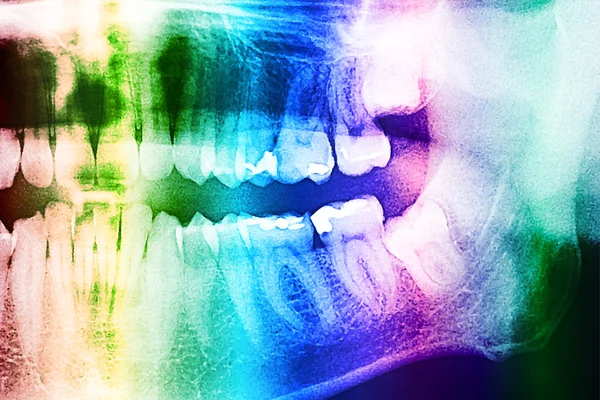 Stomatologiczne RTG zębów — Zdjęcie stockowe