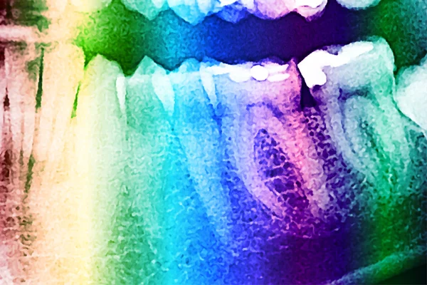 Рентген зубов — стоковое фото