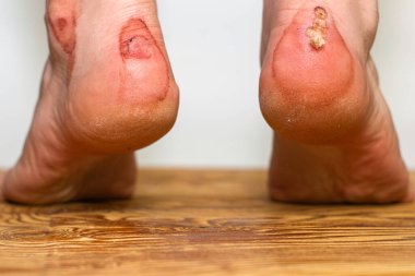 Rahatsız ayakkabılar giyen birinin kanına bulanmış. Tıp travması kavramı. Yüksek kalite fotoğraf