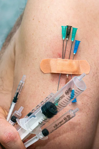 Het Begrip Vaccinatie Betekent Dat Verschillende Naalden Uit Injectiespuiten Hand — Stockfoto