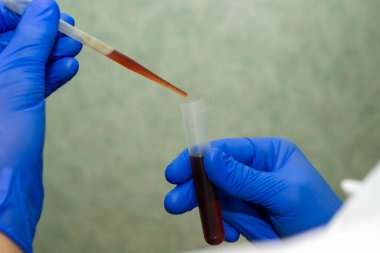 Beyaz önlüklü ve mavi eldivenli bir tıp çalışanı analiz için pipetli bir test tüpünden kan alıyor. Yüksek kalite fotoğraf