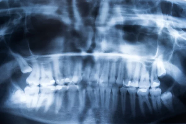 Panoramic Dental X-Ray Of Human Teeth — Stock Photo, Image