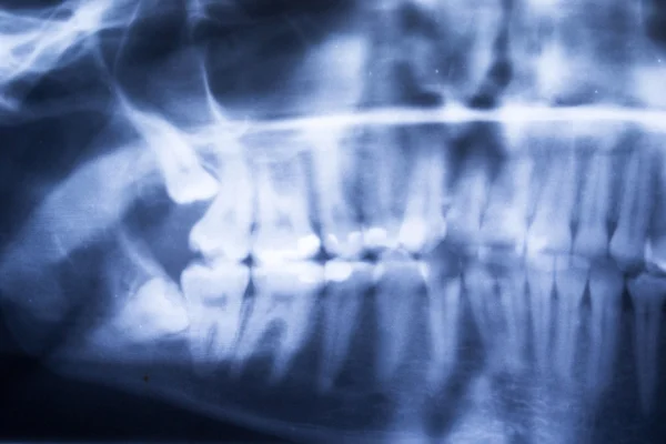 Radiografia dentale panoramica dei denti umani — Foto Stock