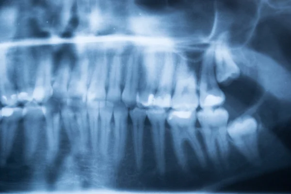 Radiografia dentale panoramica dei denti umani — Foto Stock