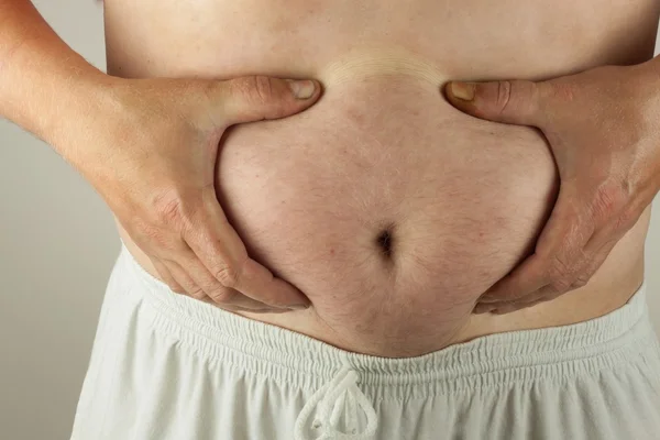 Mann hält seinen zu dicken Bauch. Gesundheitsrisiko Fettleibigkeit. — Stockfoto